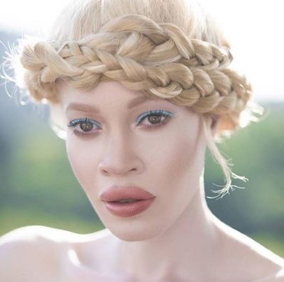 These are 2 models with Albinism